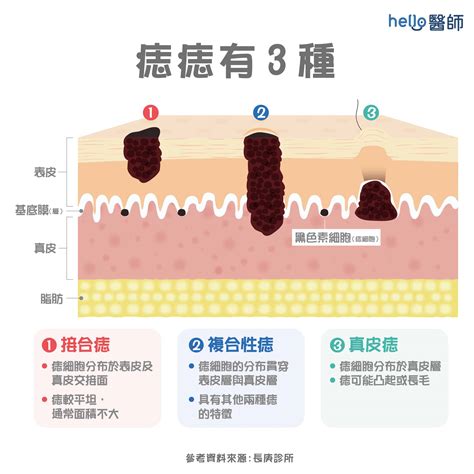 胸部長很多痣|為什麼臉上的痣越來越多？皮膚科醫師解析長痣原因、。